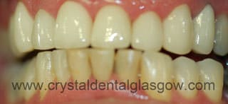 8 Metal free crowns after