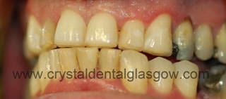 DSCDGBefore 8 Metal free crowns before