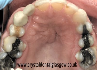 amalgamfillingsbeforetreatment amalgam fillings before cosmetic treatment
