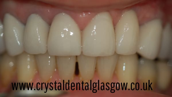 ceramic porcelain crown on single implant after