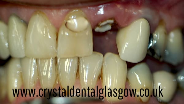 ceramic porcelain crown on single implant before