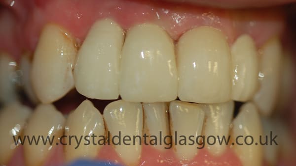 ceramic zirconia bridge after