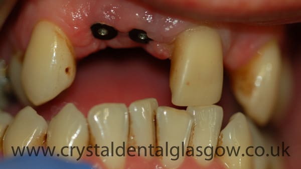 ceramic zirconia bridge before