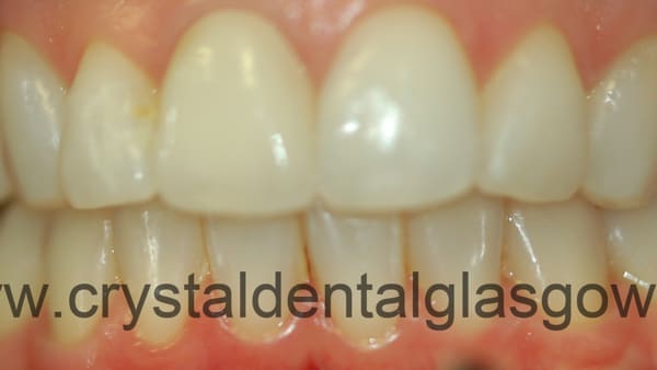 clear-braces-treatment-after clear braces treatment before