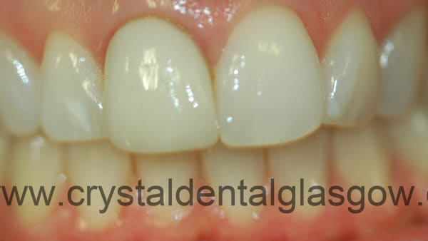clear-braces-treatment-before clear braces treatment before