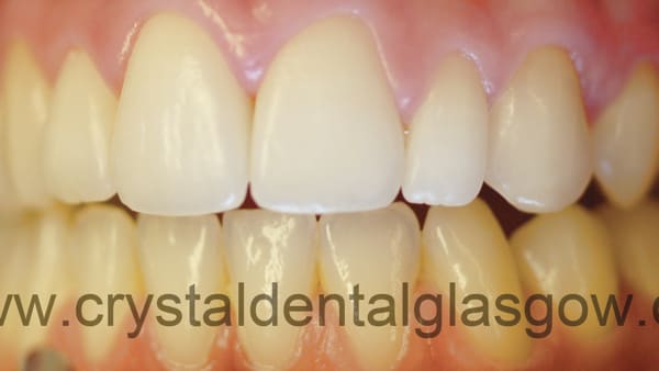 cosmetic-braces-after cosmetic braces after