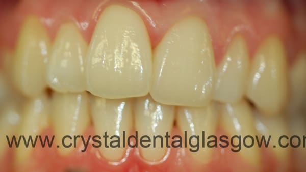 cosmetic-braces-before cosmetic braces before