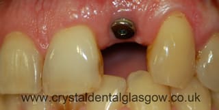 dental implant placed