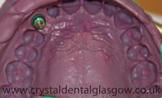 dental impression with implant