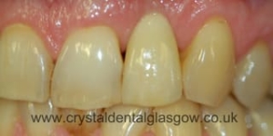 An implant crown in place