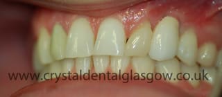 implant matched to central incisors