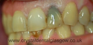 discoloured and infected tooth