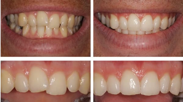 inman aligner before and after