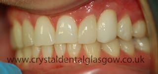 veneer added to lateral incisor