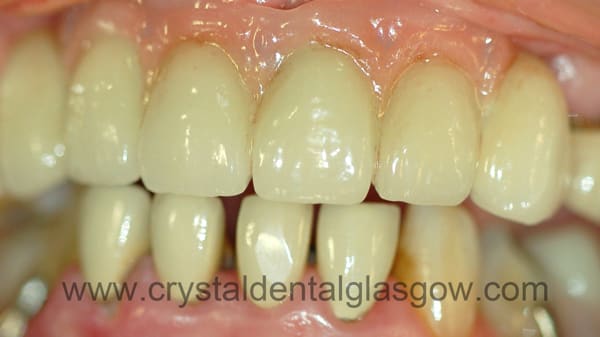 porcelain-bonded-bridge-after porcelain bonded to gold bridge after