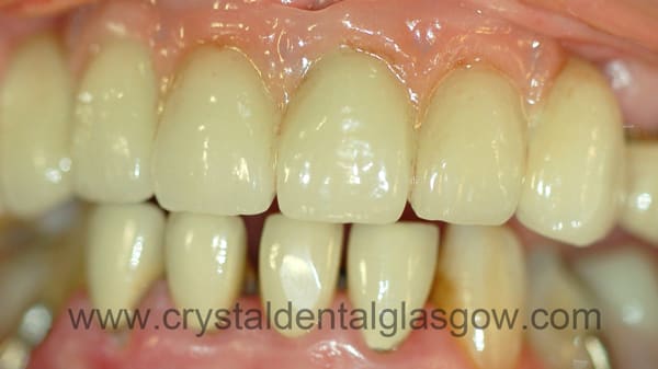 porcelain bonded to gold bridge after