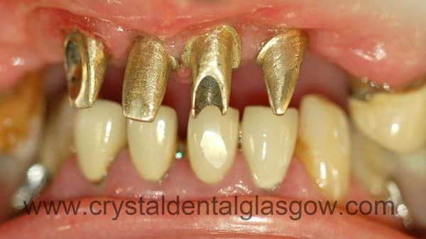 porcelain bonded to gold bridge before