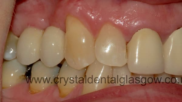 single-dental-implant-after dental implant with cantilevered bridge after