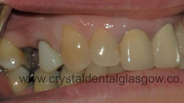 single-dental-implant-before dental implant with cantilevered bridge before
