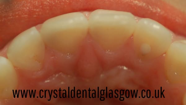 six-month-smiles-results-after six month smiles result after