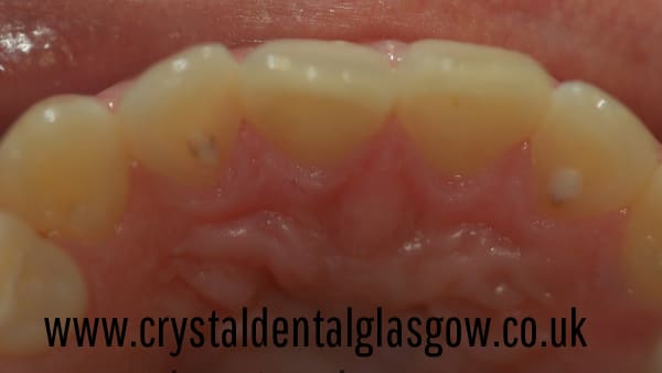 six month smiles result before