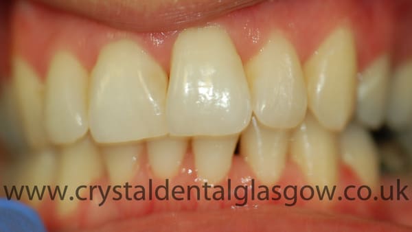six month smiles treatment after
