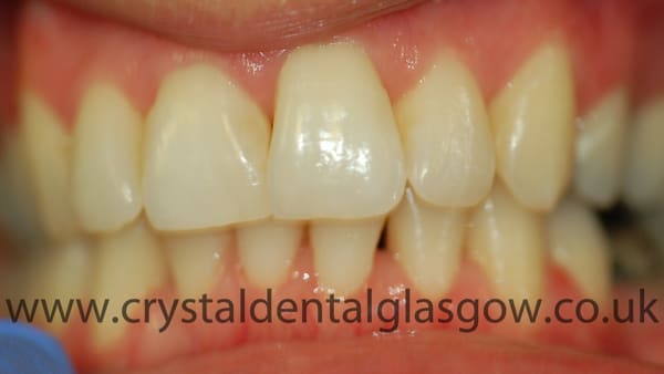six-month-smiles-treatment-after six month smiles treatment after
