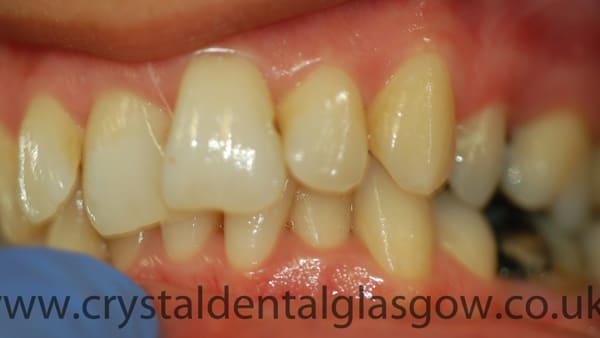 six month smiles treatment before
