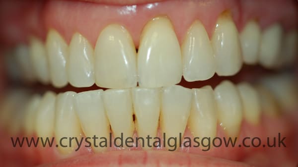 six month smiles with whitening after