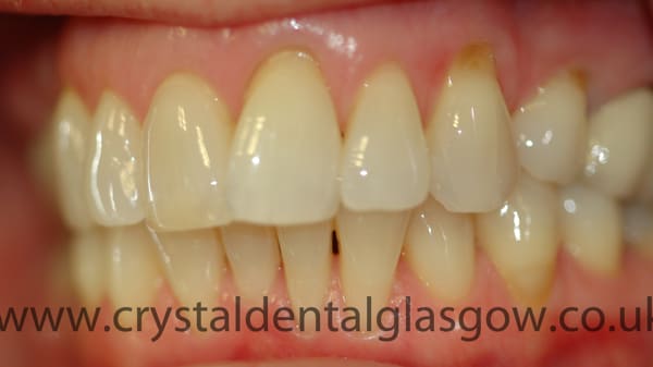 six month smiles with whitening before