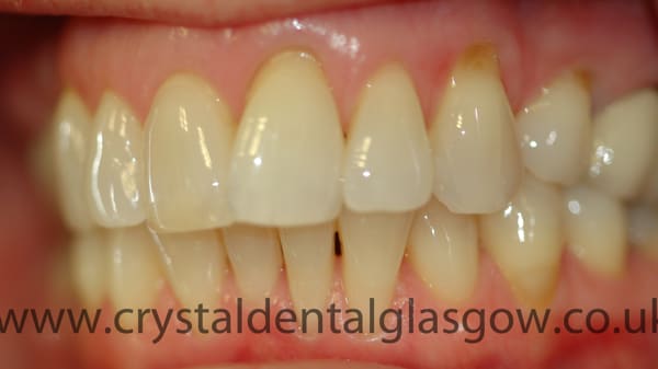 six-month-smiles-with-whitening-before six month smiles with whitening before
