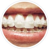 six month smile braces on a patient