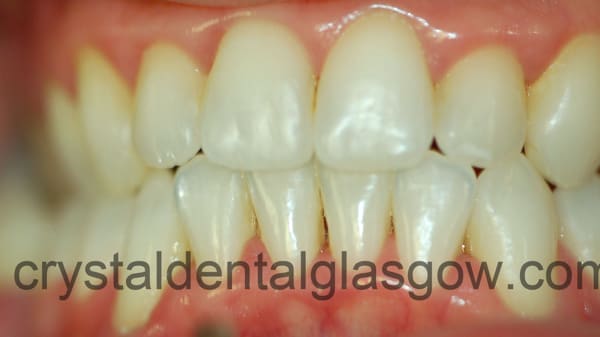 straighter-teeth-after straighter teeth after