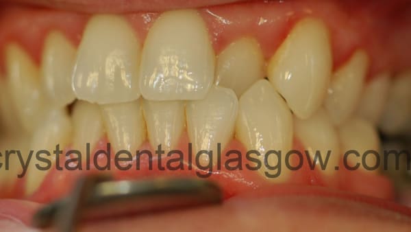 straighter teeth before