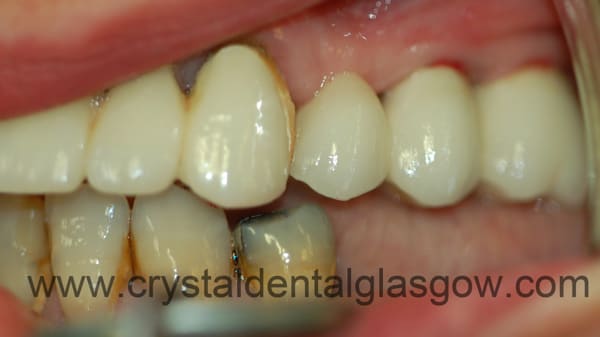 two dental implants after