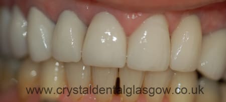 after dental implants patient image