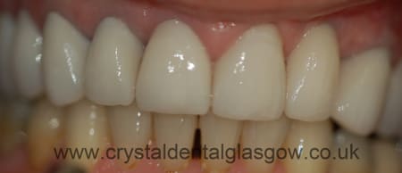 ten ceramic crowns in place