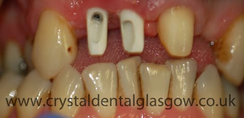 Implant bridge case patient photo 2