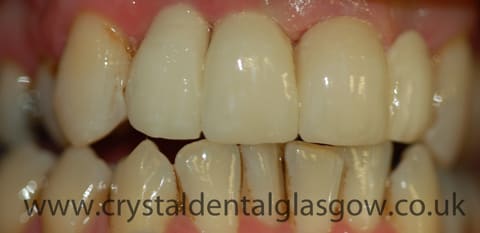 implant bridge case patient photo 3