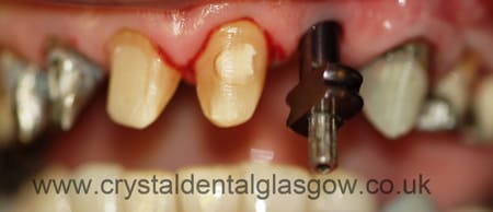 perparation for dental implant image 1