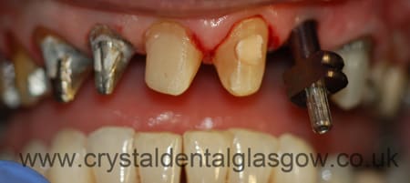 preparation for implant dental image 2
