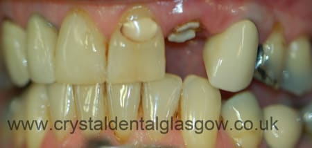 dental implant case study before image 2