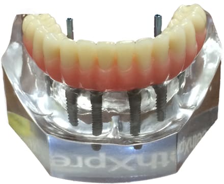 TeethXpress from BioHorizons - Teeth in a Day front view