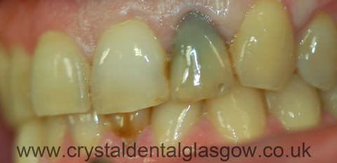 single tooth implant photo 1