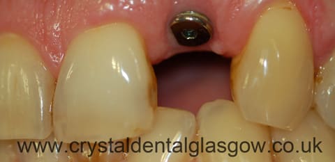 single tooth implant photo 2