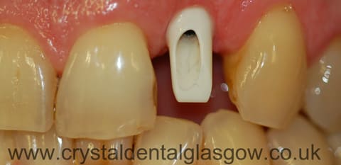 single tooth implant photo 3
