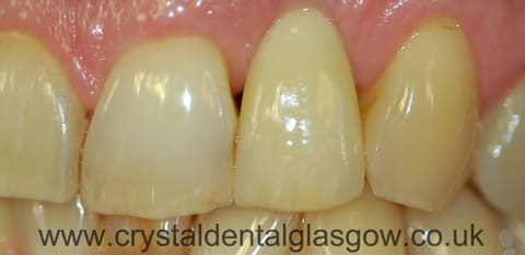 single tooth implant crown