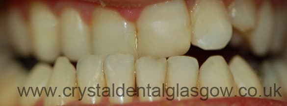 After Braces After Braces