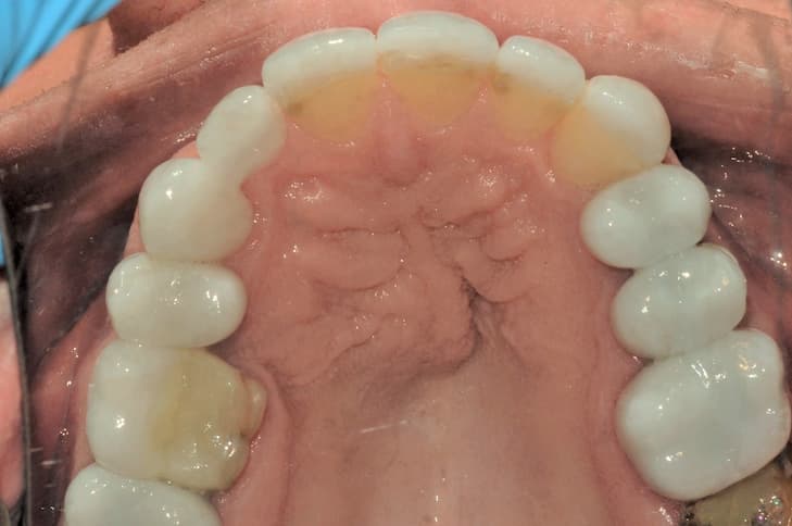 New White Fillings New White Fillings