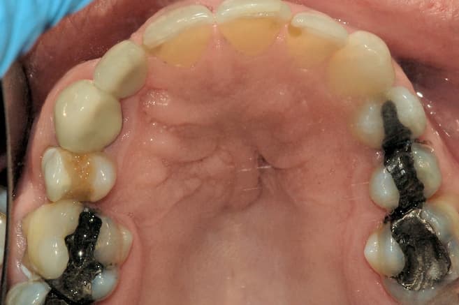 Old Amalgam Fillings Old Amalgam Fillings